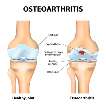 Ayurvedic treatment in Kerala for Osteoarthritis